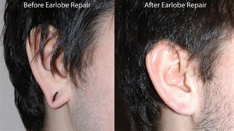 20 Minute Procedure Can Repair Ripped Earlobes Abc13 Houston