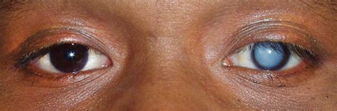 cataracts treatment symptoms   eye care doctor