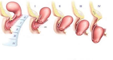 grades of uterine prolapse vinmec