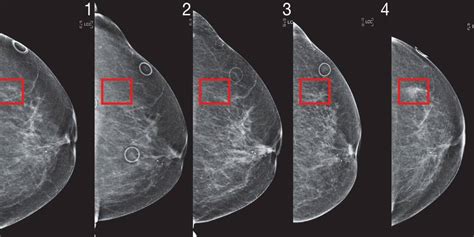 mammogram based breast cancer risk model could lead to better screening