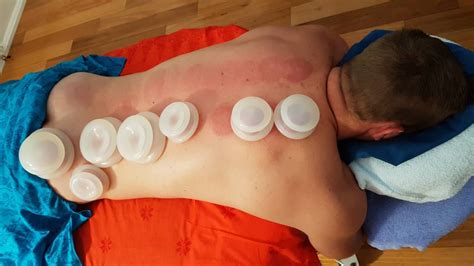 myofascial cupping james maddock remedial massage melbourne