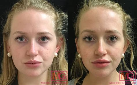 Dr Michele Green Nyc Based Anti Aging Expert On Lip Fillers
