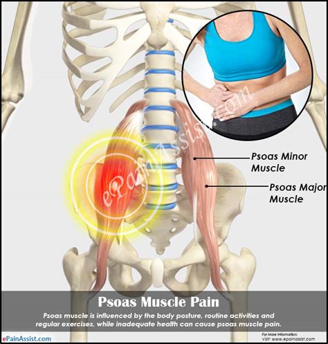 Psoas Muscle Pain And Techniques To Release Psoas Muscle