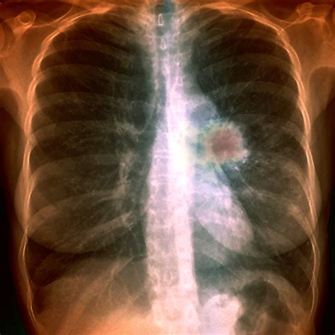 lung cancer postoperative complications reduced  preoperative