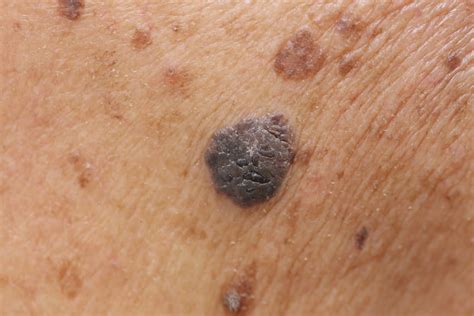 Cancerous Moles What To Look For Water S Edge Dermatology