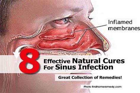 effective natural cures  sinus infection