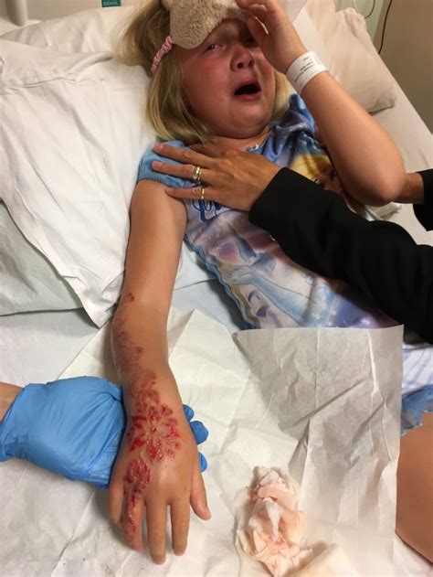 Black Henna Tattoo Scars Girl S Arm Leaving Her In Agony Metro News