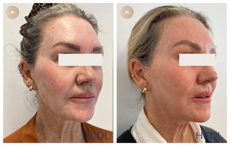 rejuvenate  skin   carbon dioxide laser treatment dermatologist led