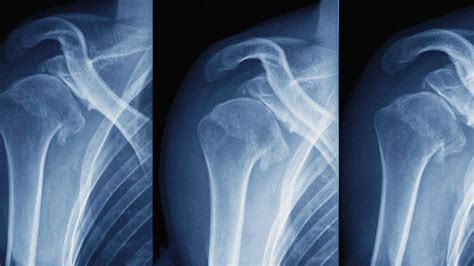Dislocated Shoulder What To Do Symptoms Treatment And More