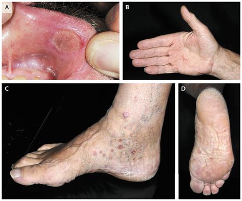 Primary And Secondary Syphilis Nejm