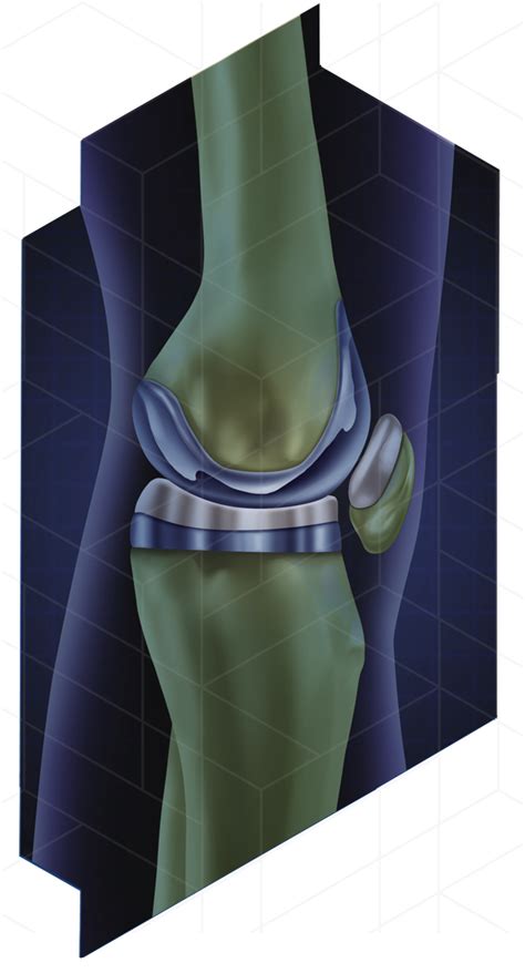 Revision Knee Replacement Jeffrey A Geller Md