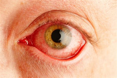 covid symptoms sore itchy eyes   early coronavirus warning sign experts