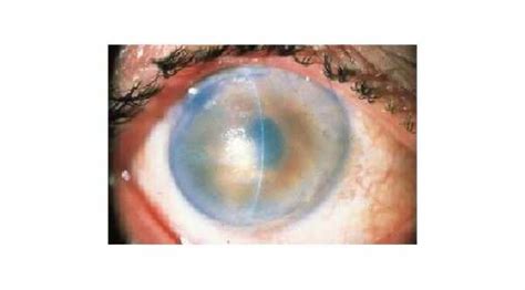 Corneal Edema After Cataract Surgery Ask The Eye Doctor