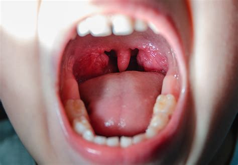 Learning Center Information On Tonsils And Adenoids
