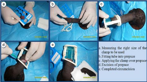 Circumcision Process Using Alisklamp Download Scientific Diagram