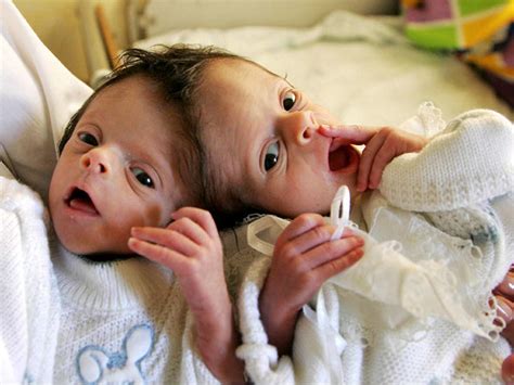 conjoined twins 40 amazing photos graphic images photo 26