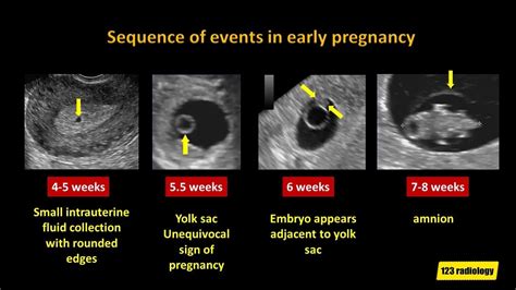 Early Pregnancy Failure A Simplified Ultrasound Approach