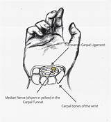 Tunnel Carpal Labels Symptoms sketch template