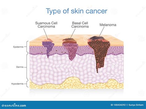 skin cancer squamous cell carcinoma basal cell cancer  melanoma