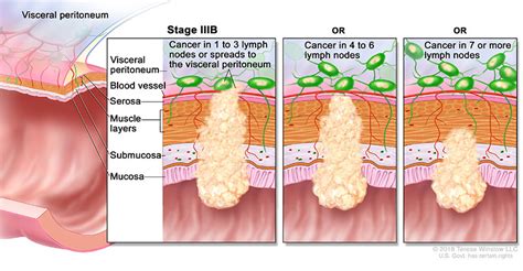 Colon And Rectal Cancer Staging Affiliated Oncologists