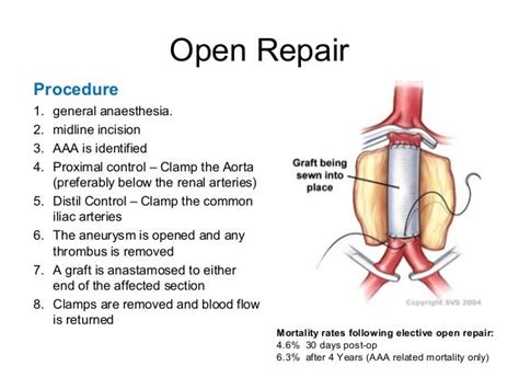 rough guide  abdominal aortic aneurysms