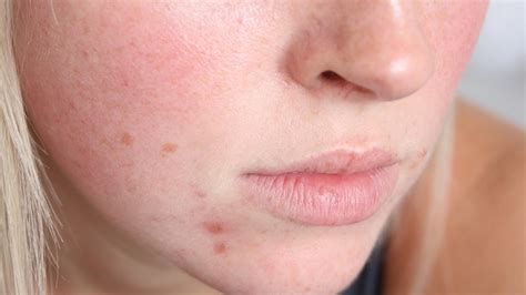 How To Eliminate The 8 Most Common Types Of Dark Spots