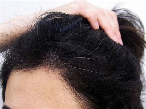 best female hair transplant female before and after hair transplant