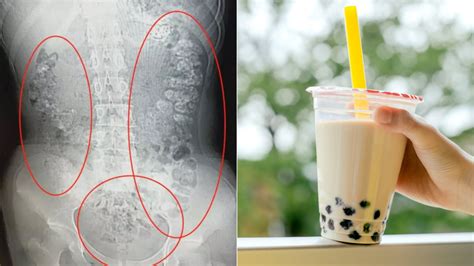 ‘bubble Tea Girl’ Teen In Coma After Addiction To Sugary Drink 7news