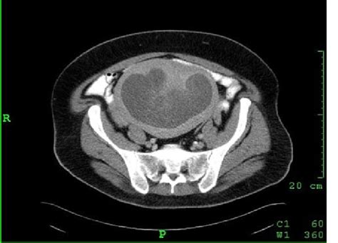 ct scan reveals an enlarged uterus with thickened walls and hematometra