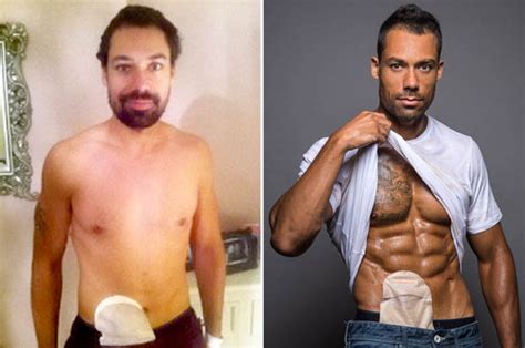 bodybuilder loses career to ulcerative colitis becomes physique model