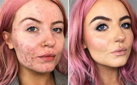 makeup  acne skin