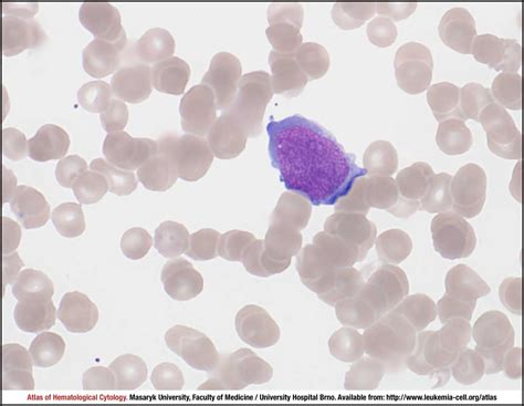 anaplastic large cell lymphoma alk positive cell atlas