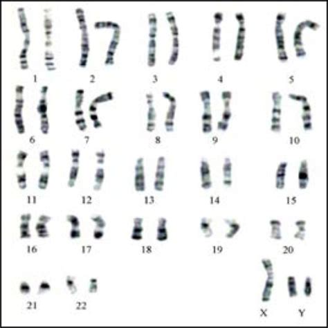 karyotype of aneuploidy 47 xyy open i