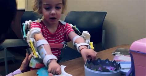 3d printer helps 4 year old girl who can t use her arms