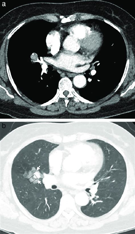 Computed Tomography Ct Features Of Pulmonary Sclerosing Pneumocytoma