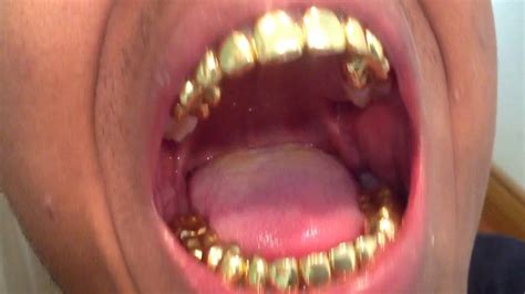 cost   gold teeth implants teeth poster