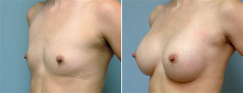 natural male breast enlargement