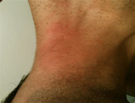 itchy neck pictures symptoms treatment rash   updated