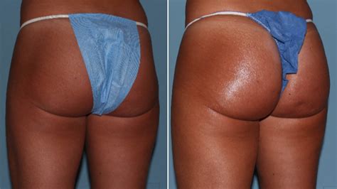 non surgical butt lifts are the new plastic surgery trend