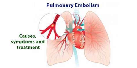 What Is Pulmonary Embolism Causes Symptoms And Treatment