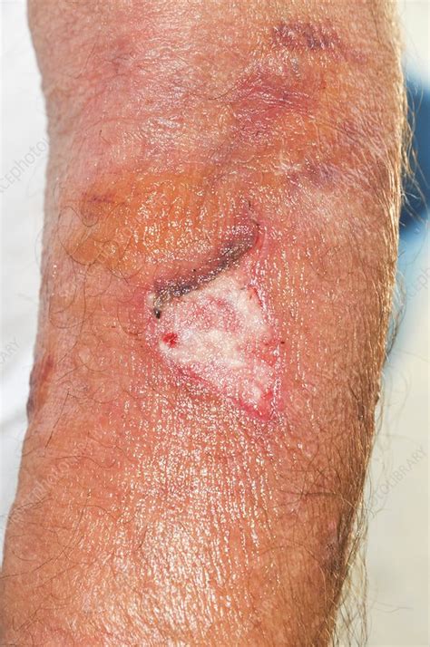 infected wound stock image  science photo library