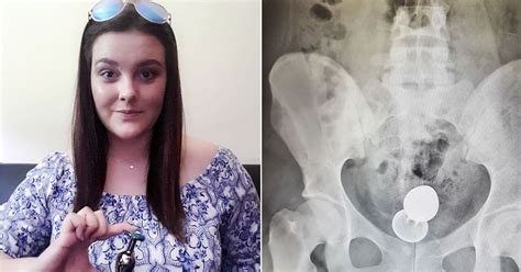 woman issues warning after having four inch sex toy surgically removed