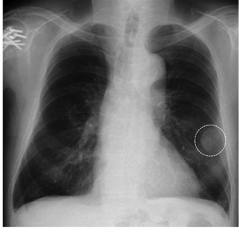 Chest X Ray Showing A Mass Shadow On The Left Circled Download
