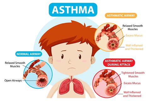 asthma diagram  normal airway  asthmatic airway  vector art  vecteezy