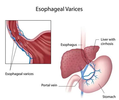 esophageal varices pathophysiology podcast  nursing care plan