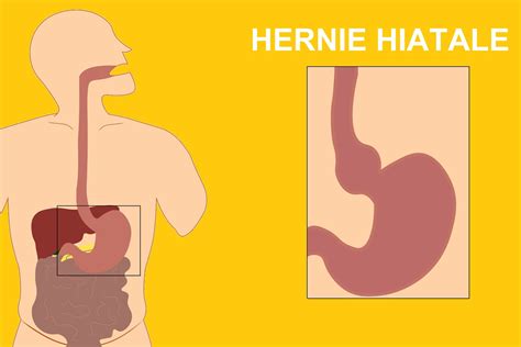 Hernie Hiatale Symptômes âge Cause Quand Opérer