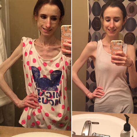23 Before And After Photos Of People Who Defeated Anorexia Caveman Circus