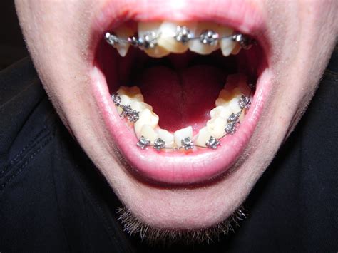 long     wear  retainer   braces