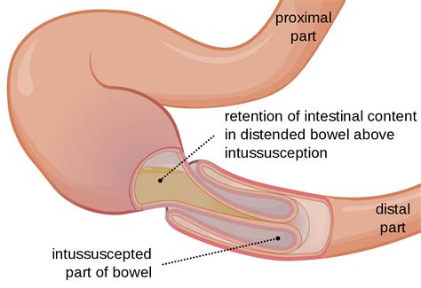 file intussusception en svg wikimedia commons