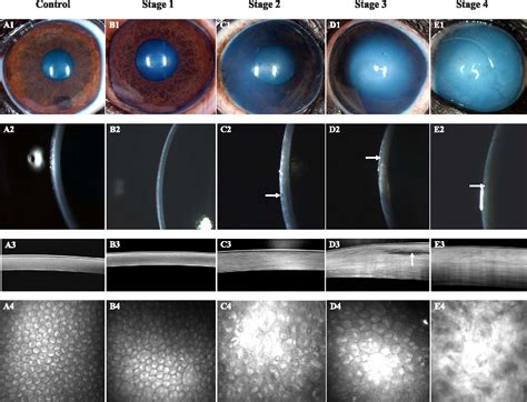 figure    vivo imaging  corneal endothelial dystrophy